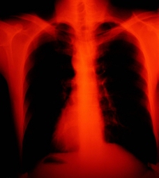 胸的X光图片