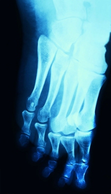 脚的X光图片