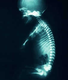 脊椎的X光图片